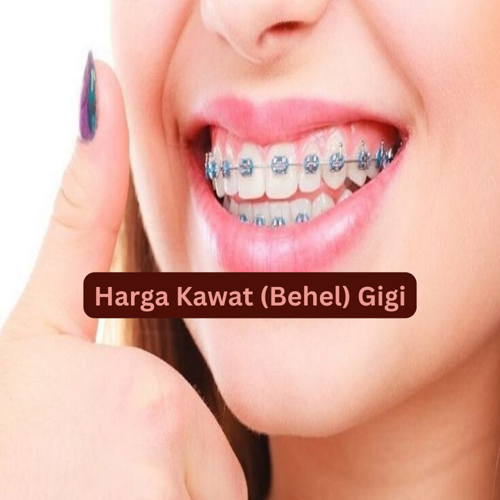 Harga kawat (behel) gigi